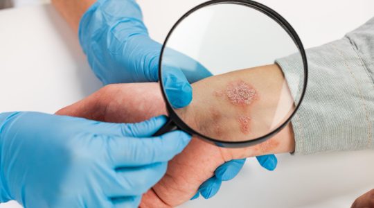 Dermatita: clasificare, cauze, tratamente și simptome