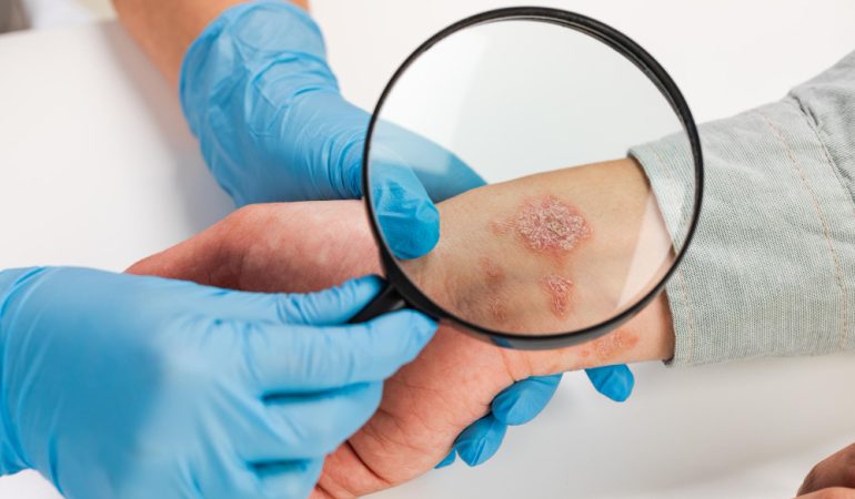Dermatita: clasificare, cauze, tratamente și simptome