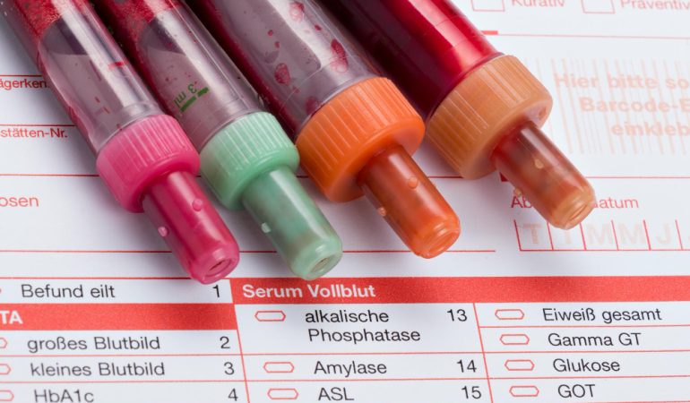 Riscurile transfuziilor: Transmiterea virusului HIV